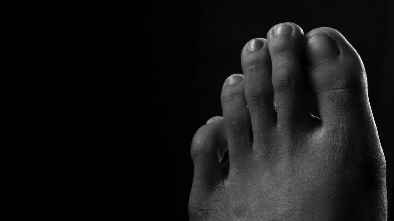 Close-up black and white image of toes with visible contracture and joint curvature, illustrating hammertoe deformity and the structural changes clinicians address in rehabilitation.